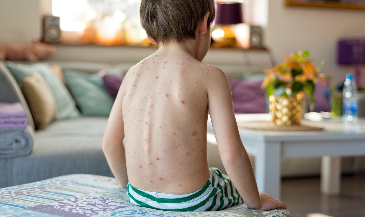 Регистрирани са 18 случая на морбили в страната